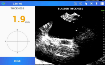 FDA-Certified Bladder Scanner