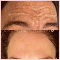 Facial Line Softening
