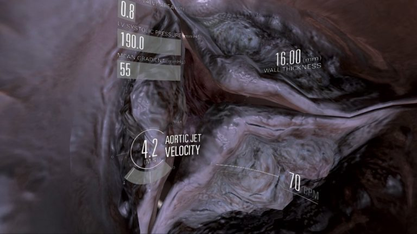 Case Studies: Virtual Valve – Medical VR