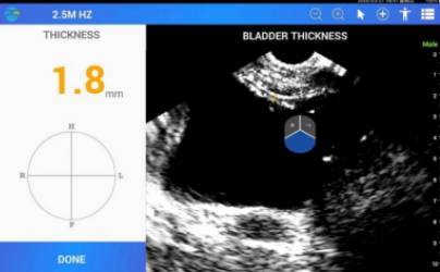PeakSonic Bladder Scanners