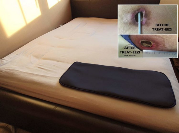 Heel Rest &minus; Very High Risk to Stage 4