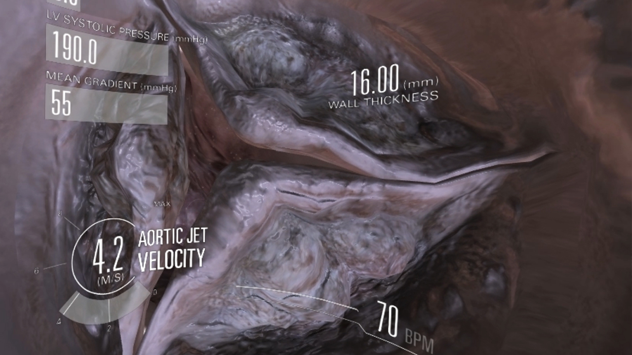 Medical VR simulation showing a detailed 3D heart valve with interactive data visualisation of blood pressure, wall thickness and aortic jet velocity.